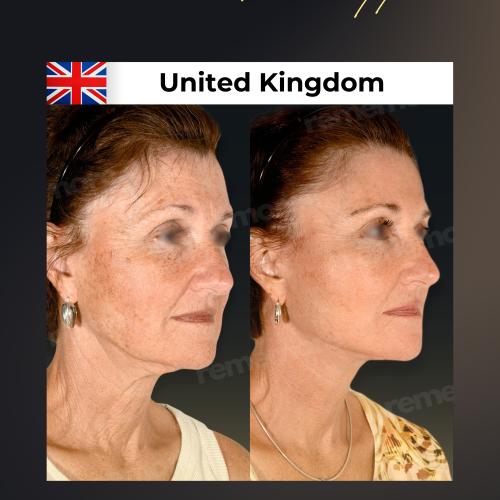 Photos Avant / Après 9